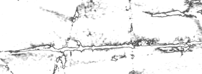 prothèse oculaire,épithèse